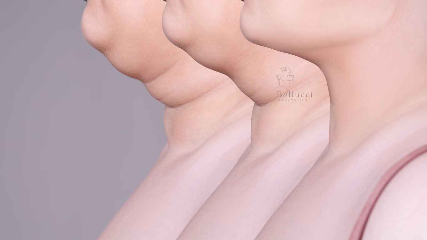 Fat Dissolving With Aqualyx - bellucci aesthetics london clinic