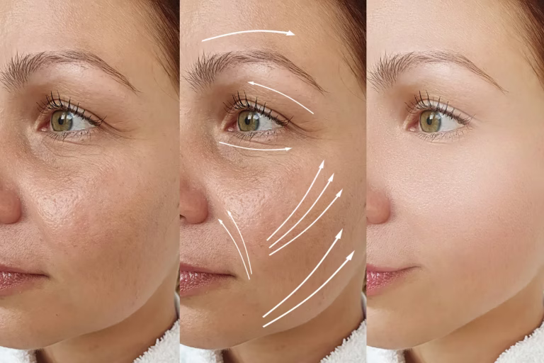 Polynucleotide skin rejuvenation treatment at Bellucci Aesthetics, London
