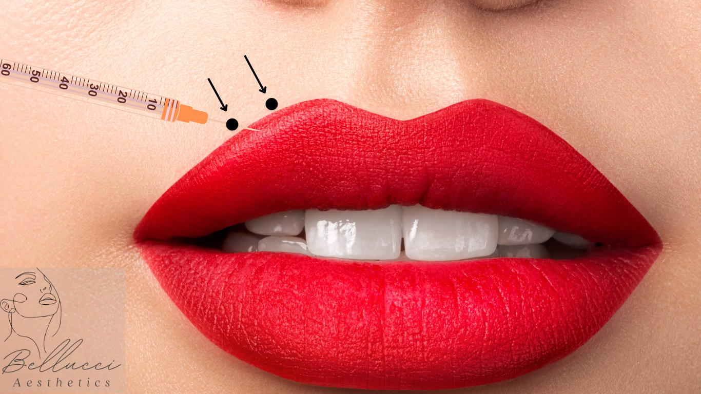 Upper lip treatment article, Bellucci Aesthetics, London