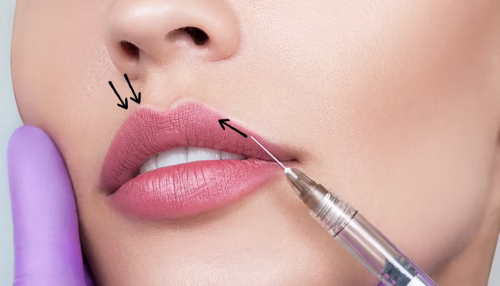 russian vs classic lips - bellucci aesthetics blog
