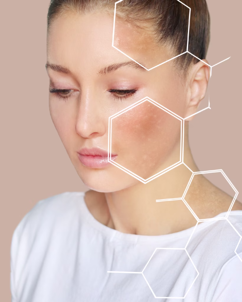 Skin boosters, Profhilo and chemical peels, Bellucci Aesthetics